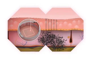 Fractional CO2 Laser Technology Principle Fractional CO2 Laser Technology Principle